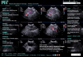 Sharpening the view in ultrasound images